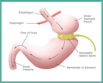 Surgical Gastric Band Procedure